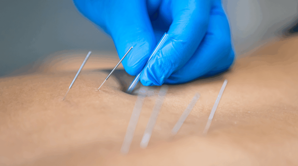 dry-needling