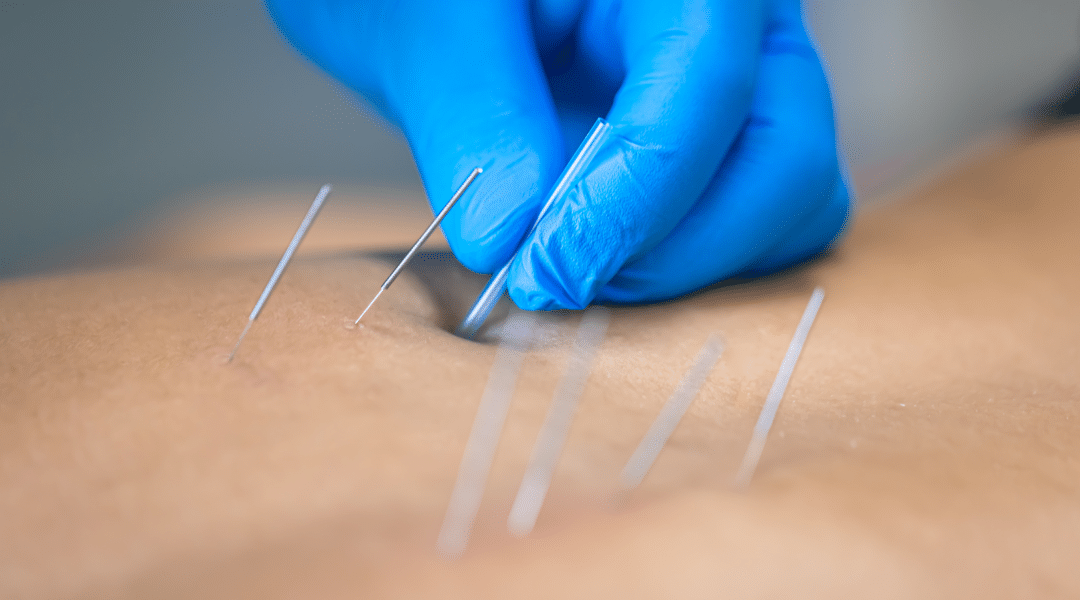 dry-needling